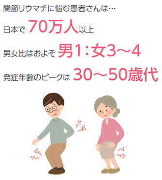 関節リウマチに悩む患者さんは日本で 70万人以上 男女比はおよそ 男1：女3～4 発症年齢のピークは 30～50歳代